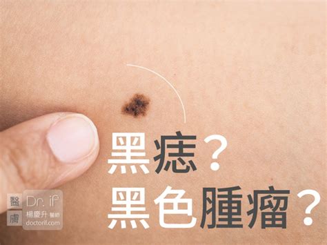 臉上的痣|不大驚小怪！如何辨別「黑痣」與「黑色腫瘤」？ 